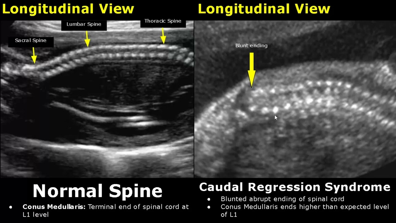 Fetal Spine Ultrasound Normal Vs Abnormal Image Appearances Spinal Fetal Spine Ultrasound Normal Vs Abnormal Image Appearances Spinal