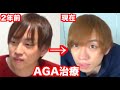 【ハゲ日記】AGA薄毛治療24ヶ月目！
