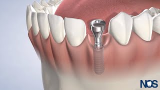 PostOp Instructions: Dental Implants at Naperville Oral Surgery & Dental Implants