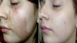 Acne soft cleanser | Best madicated acne remover cleanser Honest review#howtoremoveacne screenshot 5