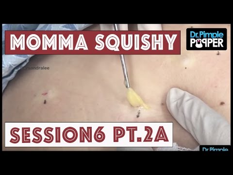 Steatocystomas & Momma Squishy: Session Six, Part 2A