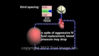 Third Spacing Fluid Response to Surgical Stress video - Animation by Cal Shipley, M.D.