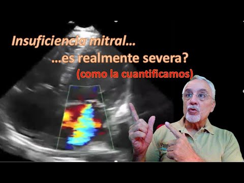 Vídeo: Como diagnosticar regurgitação mitral: 15 etapas (com fotos)