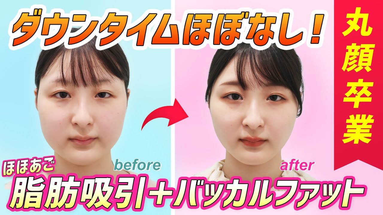 ダウンタイムほぼなし ほほあご脂肪吸引 バッカルファットで丸顔卒業 東京 銀座の美容外科クリニック Wom Clinic Ginza