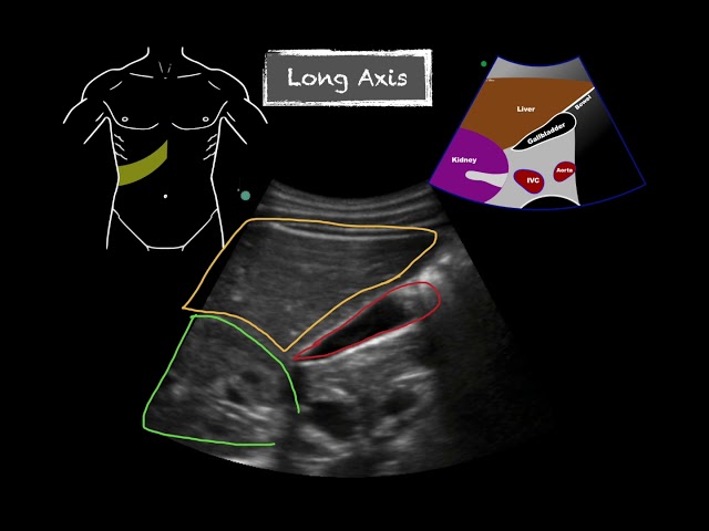 POCUS - Gallbladder Ultrasound Anatomy class=