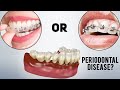 Periodontal Disease and Invisalign, Braces or ClearCorrect