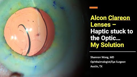 When the haptic sticks to the optic with Alcon Clareon lenses (PanOptix) – My solution.