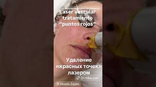 Láser Vascular estrellas arañas vasculares Удаление красных точек сосудов сосудистых звездочек Лазер