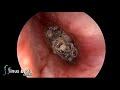 Myiasis of the ear