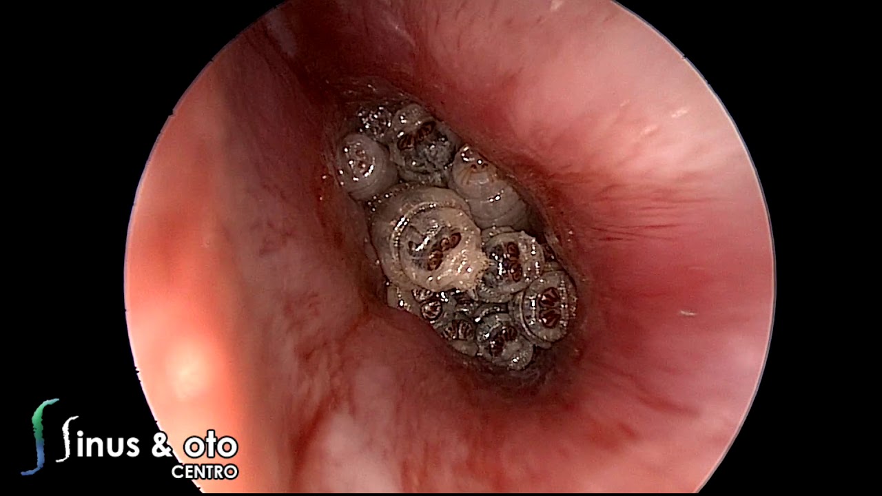 Myiasis of the ear 