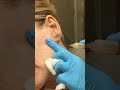 Renuva: Fast, Long-Lasting Volume