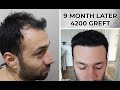 9 MONTH LATER | 4200 GREFT | FUE METHOD | SAPPHİRE