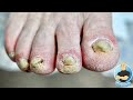 SUPER DRY THICK, RED ITCHY TOENAIL TRIMMING