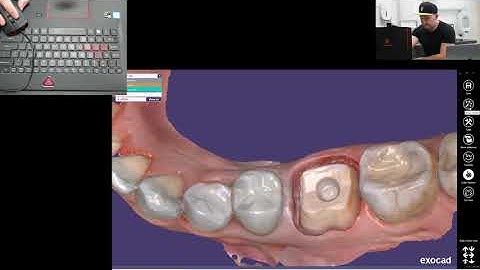 How to design knife-edge vertical crown in Exocad (Medit i500, Cerec, 3shape, Carestream)