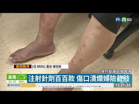 靜脈曲張求診 婦傷口潰爛險截肢 | 華視新聞 20190702