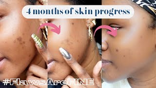 Monthly SKIN CHECK | 4 Months of Skincare Progress | #FlawsAreFINE | Breakouts & Hyperpigmentation