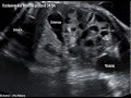 Occlusion intestinale :  la dilatation des anses grêles et une hyperpéristaltisme : foetus de 34 SA