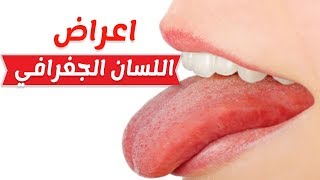 اعراض وطرق علاج اللسان الجغرافي وكيفيه تخفيف اعراض تشقق اللسان