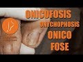 Onicofosis - Onicofose - Onychophosis [Podología Integral] Integral Podiatry