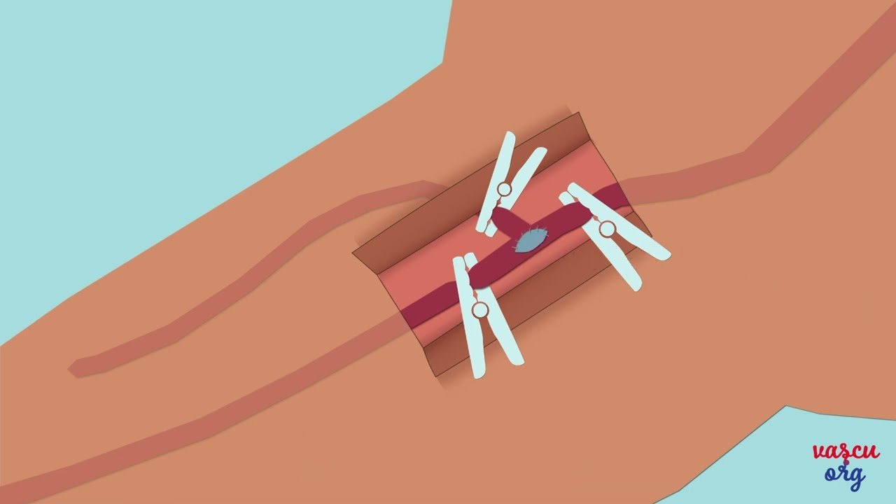 La chirurgie de l'artériopathie des membres inférieurs.