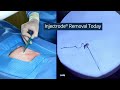 Injectrode Removal Today vs "Tomorrow"