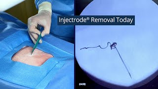 Injectrode Removal Today vs "Tomorrow"