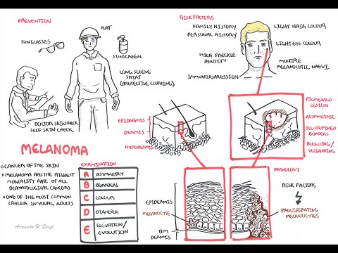 Melanoma - Overview (signs and symptoms, pathology, risk factors, treatment)