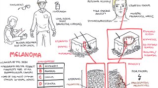 Melanoma - Overview (signs and symptoms, pathology, risk factors, treatment)