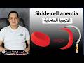 Sickle Cell Anemia 