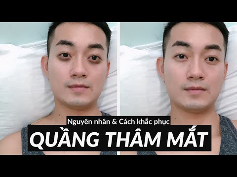 TTL - Trị quầng thâm mắt