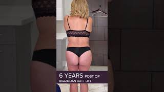 Brazilian Butt Lift 🍑  - 6 Years Post Op