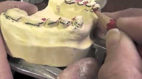 R P D Design - Ken Class IV Mand Cast #36 Part D