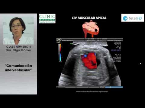 COMUNICACION INTERVENTRICULAR