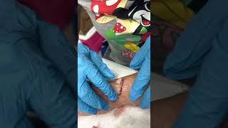 Stryker Zip Skin / ZipLine / ZipStitch wound closer in use!