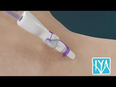 Non-tunneled Dialysis Catheter