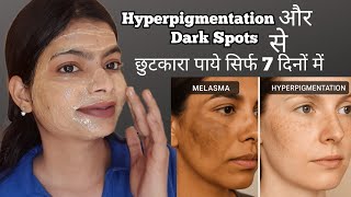Hyperpigmentation and dark spots treatment at home || How to remove pigmentation naturally