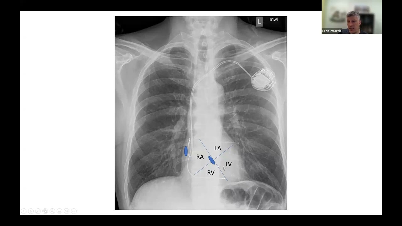 Ep1 The Cardiac Conduction System in Health and Disease - CVEF - Cardiac Device/EP Lecture Series