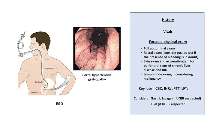 An Approach to GI Bleeding (Melena, Hematemesis, H...