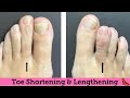 TOE LENGTHENING SURGERY ** BEFORE &amp; AFTER PRESENTATION