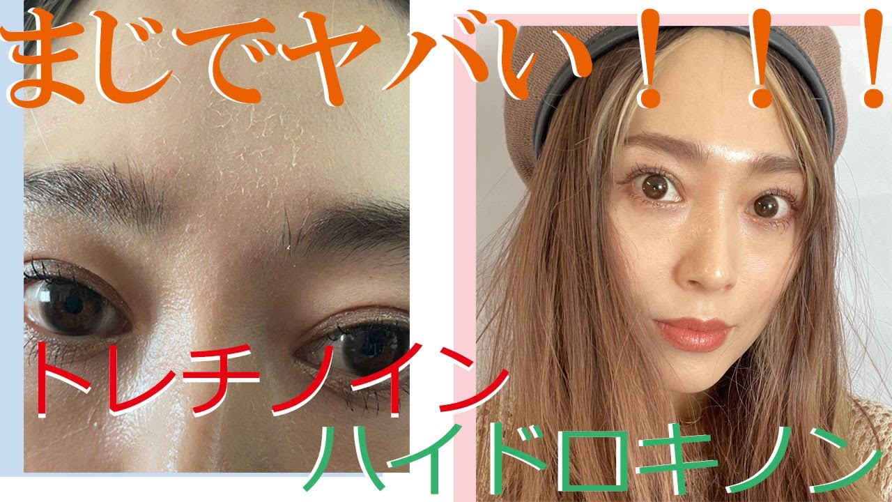 【経過】シミが消えた！？ハリがでた！？トレチノイン・ハイドロキノンやばすぎる・・・２０日間の経過。