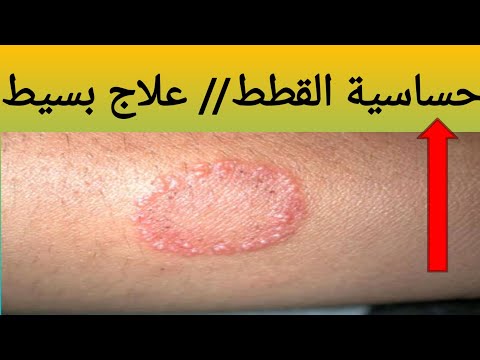 حساسية القطط و ظهور حلقات في الوجه و مناطق أخرى