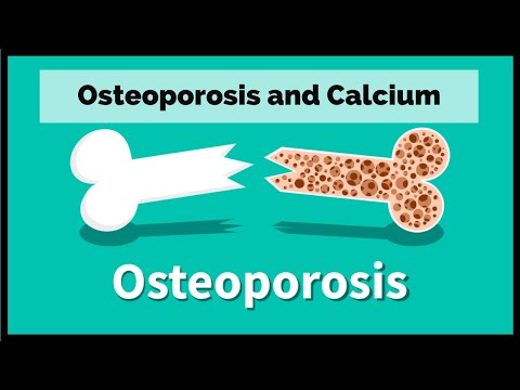 Osteoporosis & Calcium | ऑस्टियोपोरोसिस और कैल्शियम | Knee Osteoporosis treatment