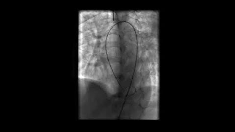 LV Angiogram in LAO Cranial view profiling a high muscular VSD