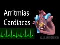 Arritmias Cardíacas, Animación. Alila Medical Media Español.