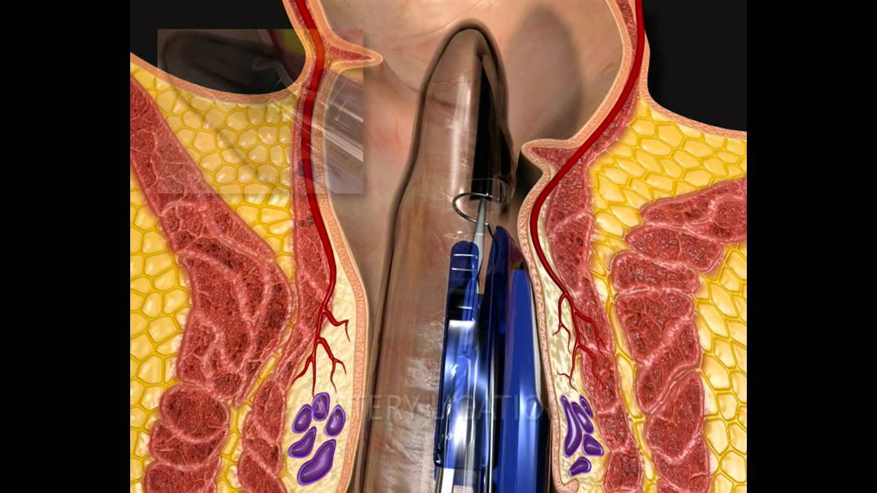 Thd Operation THD Slide Animation - YouTube