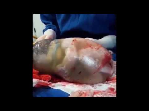 Increible bebe en placenta Amazing Baby inside placenta - YouTube