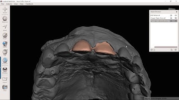 Creating a prepped tooth model in Meshmixer