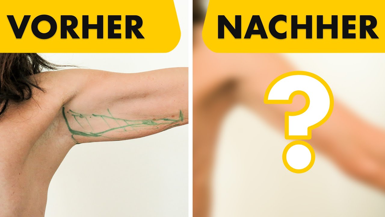 So funktioniert meine Oberarmstraffung! 2 Beispiele