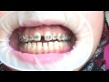 Orthodontic Wire dimple by Dr. Amr Asker at Asker Orthodontic Center