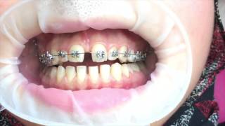 Orthodontic Wire dimple by Dr. Amr Asker at Asker Orthodontic Center
